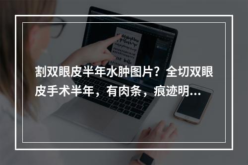 割双眼皮半年水肿图片？全切双眼皮手术半年，有肉条，痕迹明显，能继续恢复吗