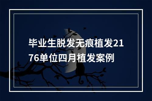 毕业生脱发无痕植发2176单位四月植发案例