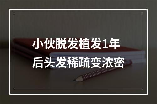 小伙脱发植发1年后头发稀疏变浓密