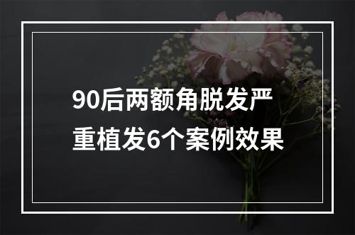 90后两额角脱发严重植发6个案例效果