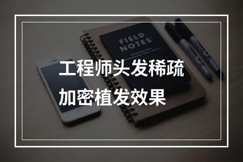 工程师头发稀疏加密植发效果