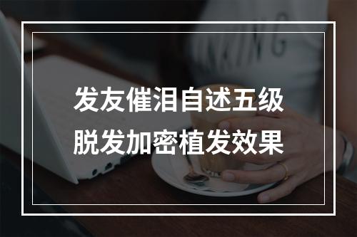 发友催泪自述五级脱发加密植发效果