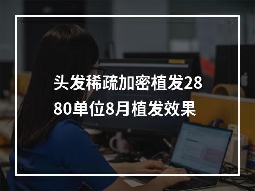 头发稀疏加密植发2880单位8月植发效果