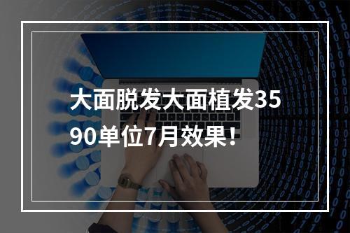 大面脱发大面植发3590单位7月效果！