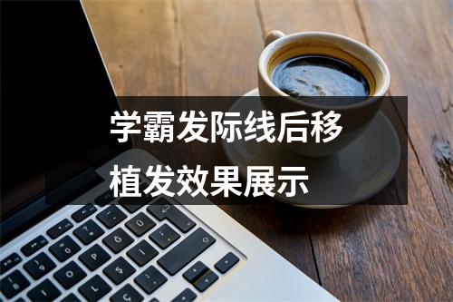 学霸发际线后移植发效果展示