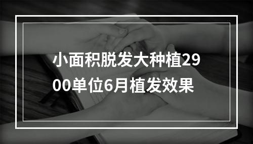 小面积脱发大种植2900单位6月植发效果