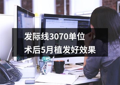 发际线3070单位术后5月植发好效果