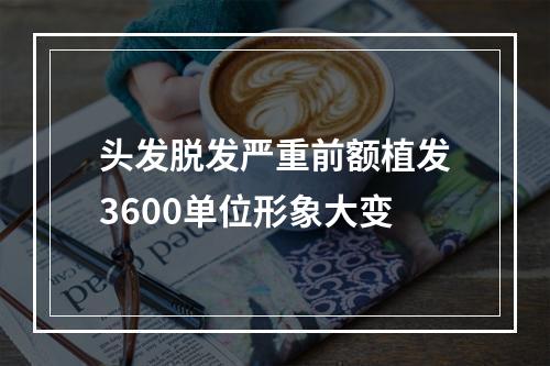 头发脱发严重前额植发3600单位形象大变