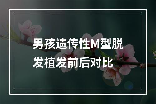 男孩遗传性M型脱发植发前后对比