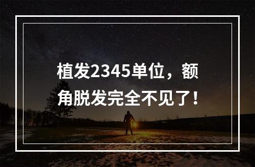 植发2345单位，额角脱发完全不见了！