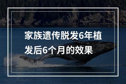 家族遗传脱发6年植发后6个月的效果