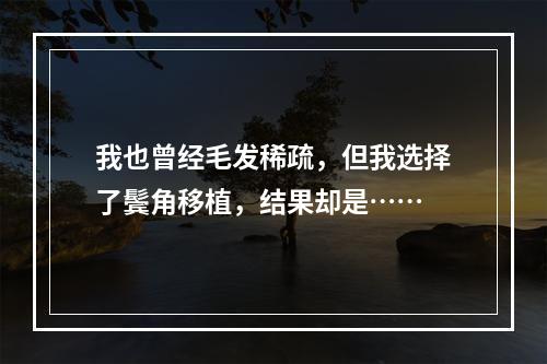 我也曾经毛发稀疏，但我选择了鬓角移植，结果却是……