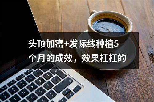 头顶加密+发际线种植5个月的成效，效果杠杠的