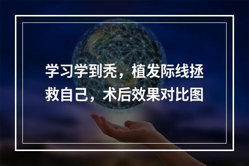 学习学到秃，植发际线拯救自己，术后效果对比图