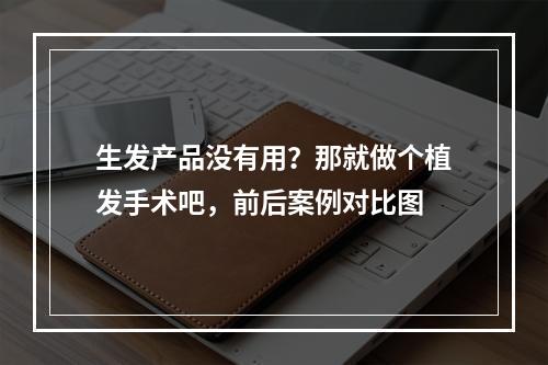 生发产品没有用？那就做个植发手术吧，前后案例对比图