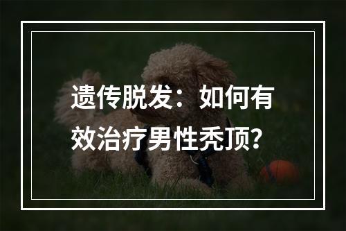 遗传脱发：如何有效治疗男性秃顶？