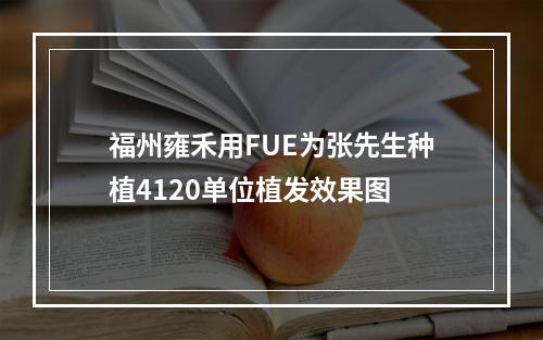 福州雍禾用FUE为张先生种植4120单位植发效果图