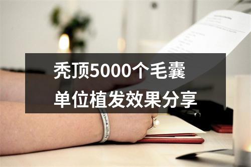 秃顶5000个毛囊单位植发效果分享