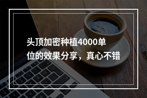 头顶加密种植4000单位的效果分享，真心不错