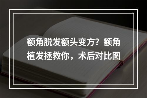 额角脱发额头变方？额角植发拯救你，术后对比图