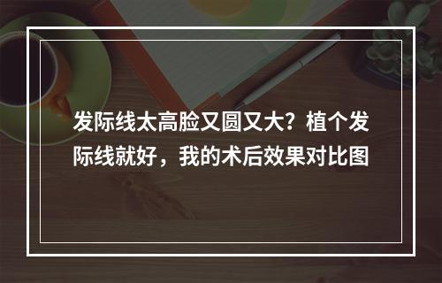 发际线太高脸又圆又大？植个发际线就好，我的术后效果对比图