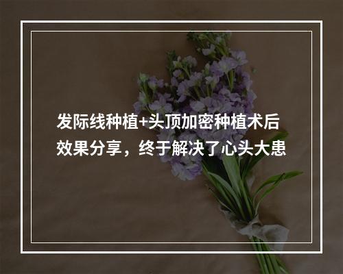 发际线种植+头顶加密种植术后效果分享，终于解决了心头大患