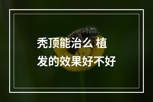 秃顶能治么 植发的效果好不好