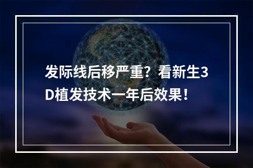 发际线后移严重？看新生3D植发技术一年后效果！