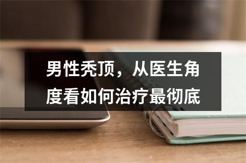 男性秃顶，从医生角度看如何治疗最彻底