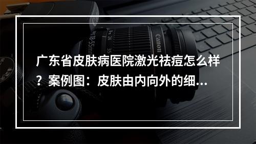 广东省皮肤病医院激光祛痘怎么样？案例图：皮肤由内向外的细腻！