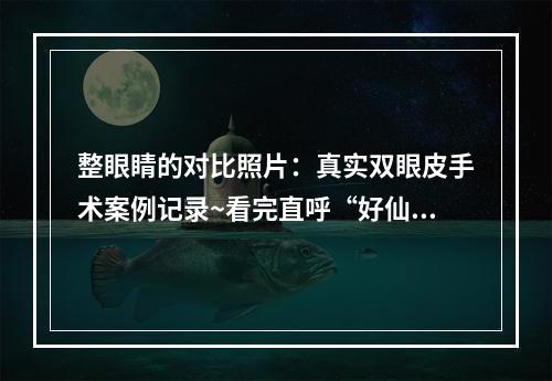 整眼睛的对比照片：真实双眼皮手术案例记录~看完直呼“好仙”