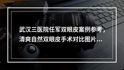 武汉三医院任军双眼皮案例参考，清爽自然双眼皮手术对比图片~