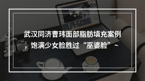 武汉同济曹玮面部脂肪填充案例，饱满少女脸胜过“巫婆脸”~