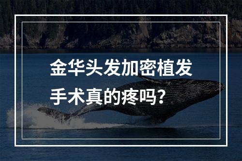 金华头发加密植发手术真的疼吗？