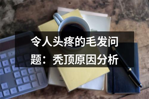 令人头疼的毛发问题：秃顶原因分析