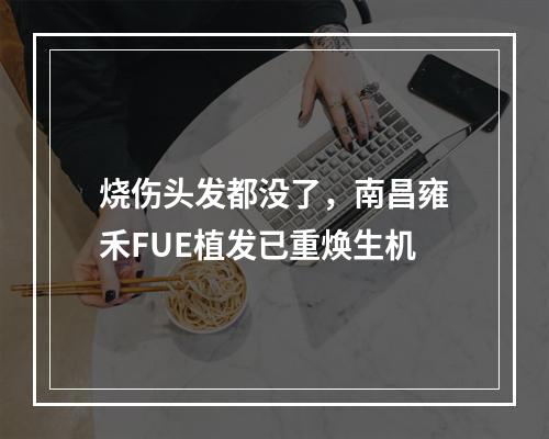 烧伤头发都没了，南昌雍禾FUE植发已重焕生机