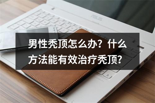 男性秃顶怎么办？什么方法能有效治疗秃顶？