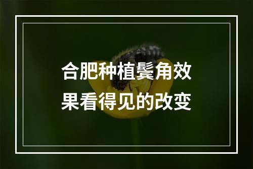 合肥种植鬓角效果看得见的改变