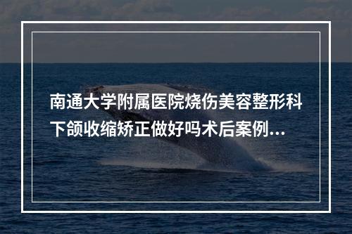 南通大学附属医院烧伤美容整形科下颌收缩矫正做好吗术后案例点评-附整形价格(费用)清单