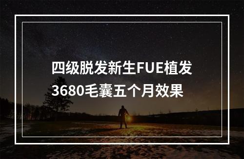 四级脱发新生FUE植发3680毛囊五个月效果