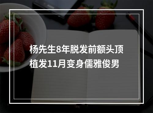 杨先生8年脱发前额头顶植发11月变身儒雅俊男