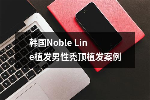 韩国Noble Line植发男性秃顶植发案例