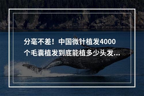 分毫不差！中国微针植发4000个毛囊植发到底能植多少头发？