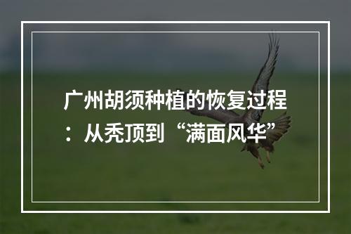 广州胡须种植的恢复过程：从秃顶到“满面风华”