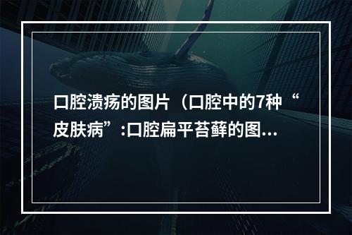 口腔溃疡的图片（口腔中的7种“皮肤病”:口腔扁平苔藓的图片）