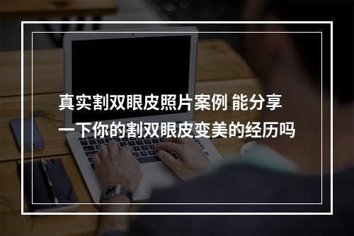 真实割双眼皮照片案例 能分享一下你的割双眼皮变美的经历吗