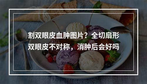 割双眼皮血肿图片？全切扇形双眼皮不对称，消肿后会好吗