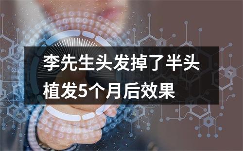 李先生头发掉了半头植发5个月后效果