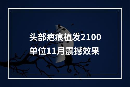 头部疤痕植发2100单位11月震撼效果