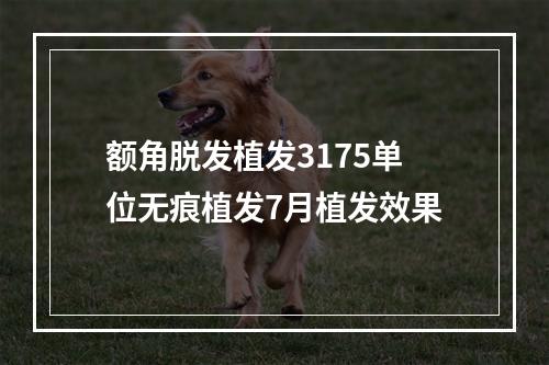 额角脱发植发3175单位无痕植发7月植发效果